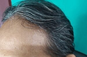 Hair transplant for receding hairline - creative commons pic by Egie Satari