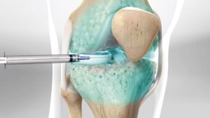 Hitting the wall with joint pain: When doctors finally suggest the needle