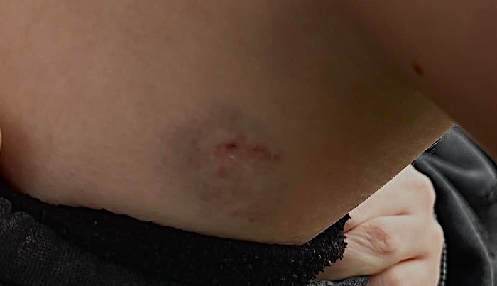 dog attack bite wounds