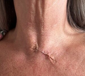 Claire Jordan - skin cancer