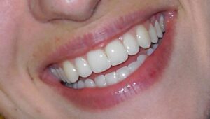 dentistry - dental veneers - feature