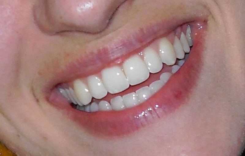 dentistry - dental veneers - feature